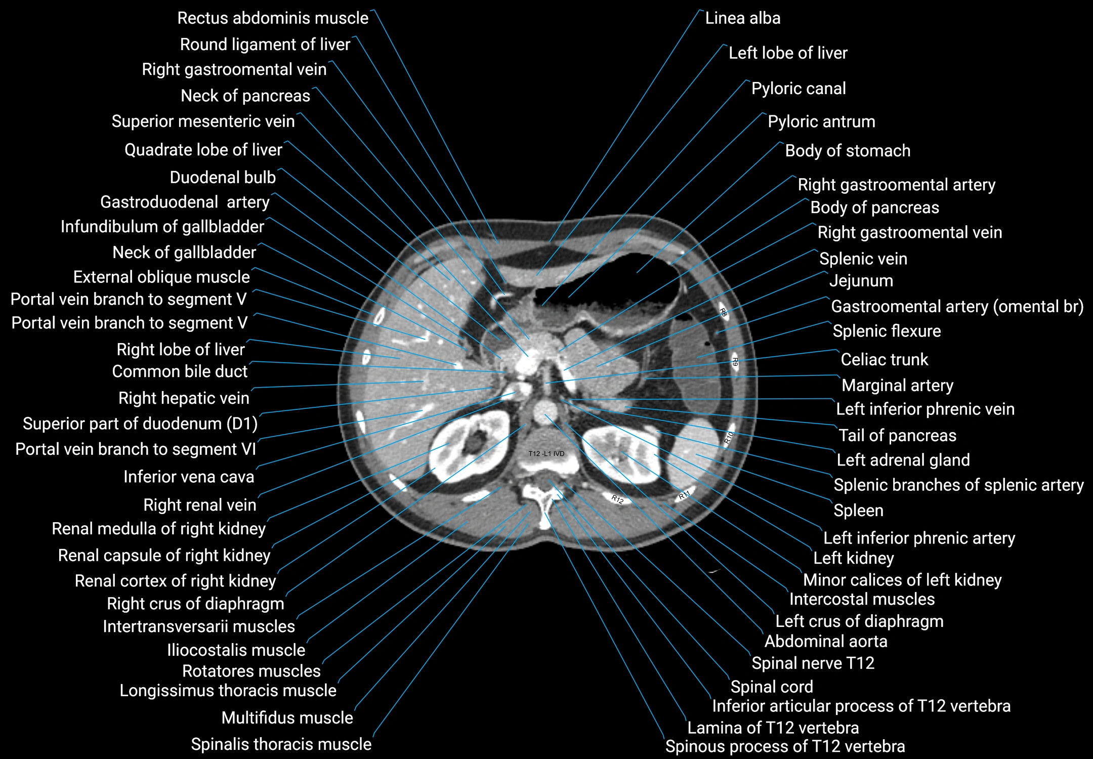 CT male pelvis axial cross sectional anatomy labelled radiology image -00049.webp